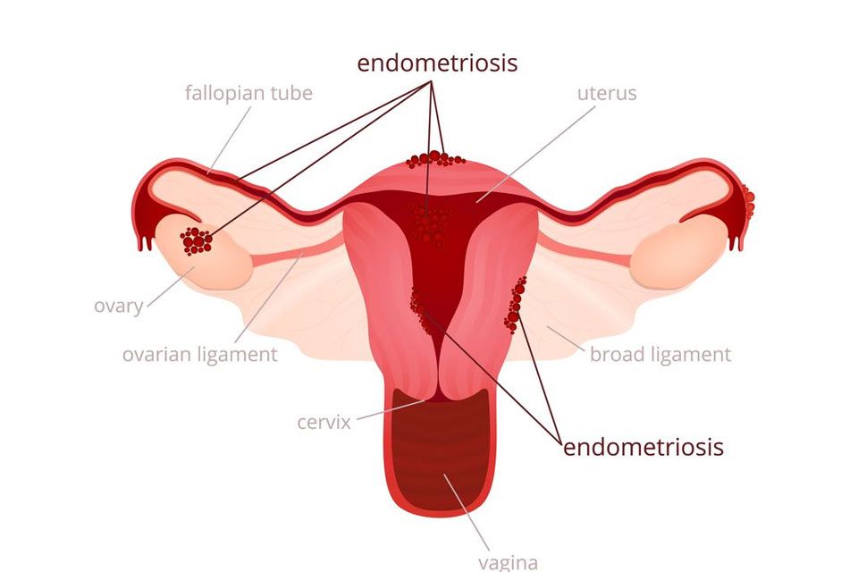 Illustration of uterus showing endometriosis
