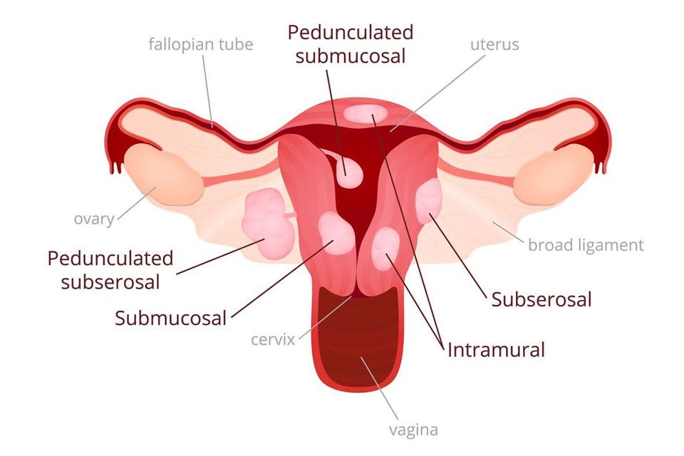 Illustration of uterine fibroids